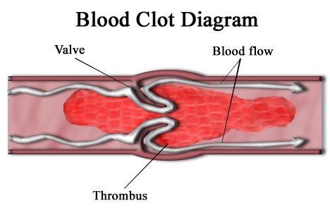 aus https://commons.wikimedia.org/wiki/File:Blood_clot_diagram.png